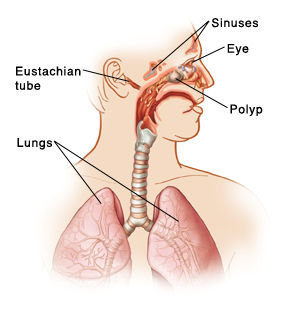Outline of man's head and chest with head turned to side showing swollen sinuses, nasal polyps, postnasal drip, and red eye.