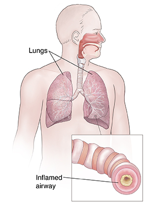 Front view of man showing respiratory system. Inset shows inflamed airway.