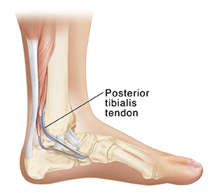 Side inside view of bones of lower leg and foot showing posterior tibialis tendon.