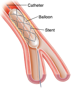 Cross section of artery showing balloon catheter placing stent.