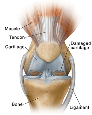 Front view of knee showing osteoarthritis.