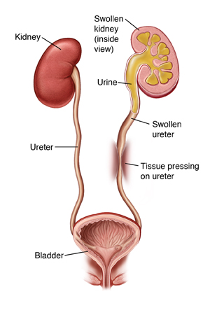 Front view of kidneys, ureters, and bladder. Tissue outside one ureter is compressing it and making urine back up into kidney.