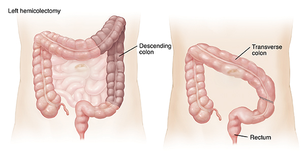 Outline of adult abdomen showing large and small intestines. Shaded area on left colon shows left hemicolectomy. Outline of abdomen showing transverse colon attached to sigmoid colon after left hemicolectomy.