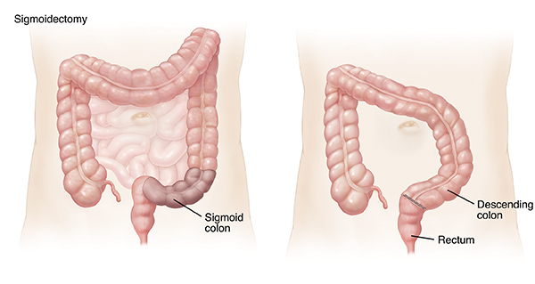 Outline of adult abdomen showing large and small intestines. Shaded area on sigmoid colon shows sigmoidectomy. Outline of adult abdomen showing descending colon attached to rectum after sigmoidectomy.