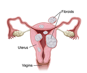 Front view cross section of uterus showing fibroids.