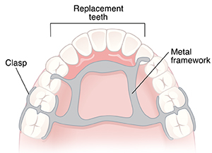 Roof of mouth and teeth showing partial denture. Clasp is around teeth. Metal framework is on roof of mouth. Framework holds replacement teeth.