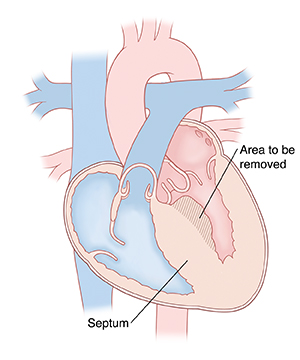 Four-chamber view of heart with thickened septum and left ventricle. Shaded area shows part of septum to be removed in septal myectomy.
