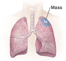 Front view of chest showing lungs. Shaded area shows wedge resection.