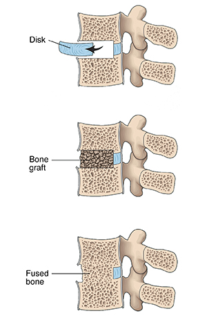 Cross section of lumbar vertebrae showing three steps in lumbar fusion.