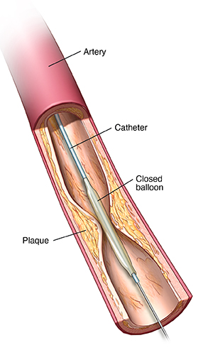 Partial cross section of artery showing balloon catheter inserted next to plaque buildup.