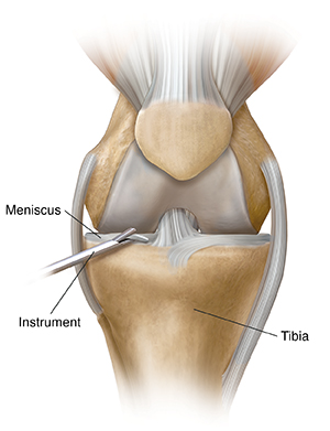 Front view of knee showing instrument removing piece of torn meniscus.