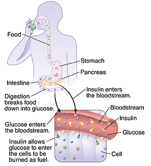 Outline of body and inset of blood vessel and cells showing how insulin and glucose work together.