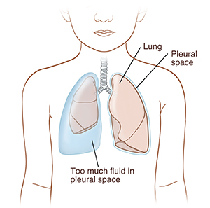 Front view of child showing fluid trapped between compressed lung and body wall on right side. Healthy lung on left.