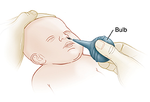 Hand inserting bulb into baby's nose. Other hand is holding baby's head steady.