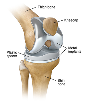 Three-quarter view of knee with total knee prosthesis in place.