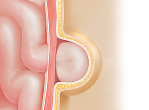 Cross section of body wall showing hernia. Intestine protruding through defect in muscle underneath skin.