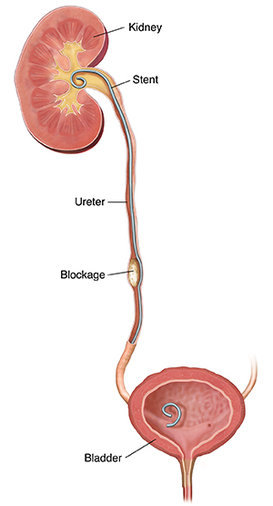 Kidney, ureter, and bladder with stent in place.