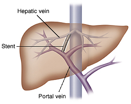 Liver showing stent connecting portal vein and hepatic vein.