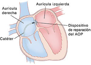Vista en cuatro cámaras de una sección transversal del corazón que muestra un catéter insertando un dispositivo de cierre del agujero oval persistente.