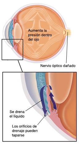 Corte transversal de un ojo donde puede verse mayor presión. Recuadro que muestra orificios de drenaje bloqueados.