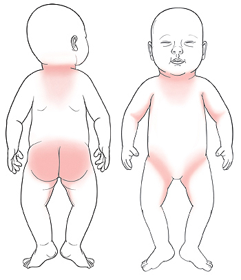 Contorno de un bebé visto desde la espalda con zonas sombreadas alrededor del cuello y sobre los glúteos y muslos internos. Contorno de un bebé visto desde el frente con zonas sombreadas alrededor del cuello, en las axilas y en la ingle.
