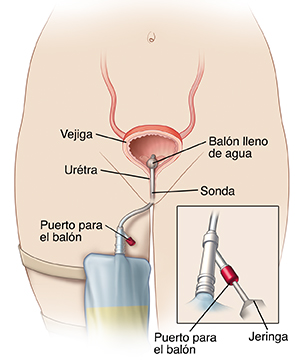 Contorno de una figura humana en el que se ve una vejiga con sonda y una bolsa de orina sobre la pierna.