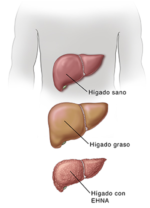 Hígado sano, hígado graso, hígado con cirrosis.