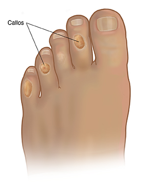 Vista superior del pie donde se observan callos en cuatro dedos pequeños del pie.