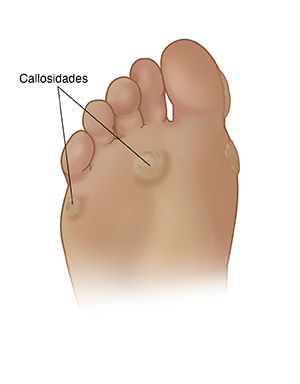 Vista inferior del pie donde se observan callos en el metatarso y el costado del pie.