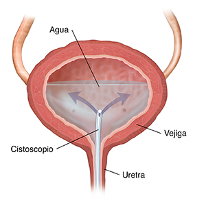 Corte transversal de la vejiga en donde se ve un catéter insertado a través del uréter que libera agua en la vejiga.