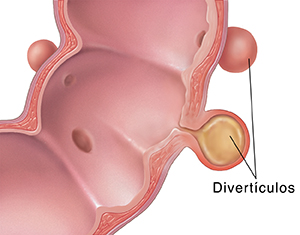 Corte transversal del colon sigmoide donde puede verse diverticulitis.