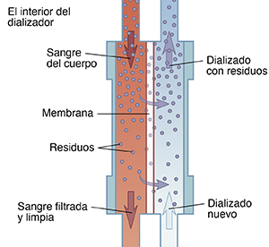 Diagrama que muestra los movimientos de la sangre a través del dializador para filtrar los desechos.