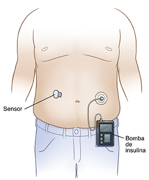 Vista frontal del torso de un hombre con el sensor del medidor de glucosa continuo en el abdomen, colocado cerca de un lado del ombligo. Receptor unido al sistema de administración de insulina en el otro lado del ombligo.