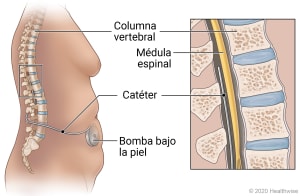 Vista lateral del torso con el catéter insertado en la columna cerca de la médula espinal. También hay una bomba bajo la piel, cerca del ombligo, conectada al catéter.