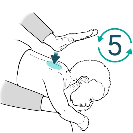 Persona sosteniendo al bebé boca abajo sobre el antebrazo y sujetando la cabeza del bebé con la mano mientras utiliza el talón de la otra mano para golpear la espalda del bebé entre los omóplatos.