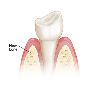 Tooth and gums after healing from tissue regeneration.