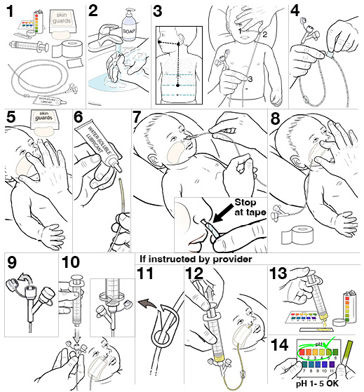 14 steps for placing an NG tube for infant.