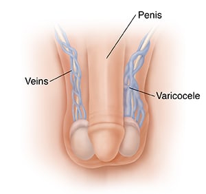 Male genitals, showing swollen veins inside scrotum.