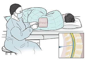 Doctor inserting needle into lower spine of draped patient lying on their side. Inset shows cross section of lumbar spine with needle inserted into spinal canal.