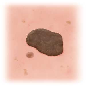 Seborrheic keratosis on light skin.
