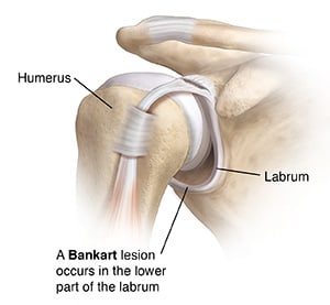 Front view of shoulder joint showing Bankart lesion.