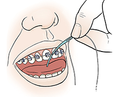 Closeup of mouth showing hand inserting floss between front teeth and under braces with floss threader.