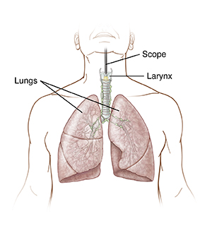 Front view of torso showing a scope inserted into throat to level of larynx.