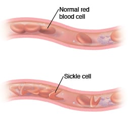 Cross sections of blood vessels, showing normal blood cells and sickle cell anemia.