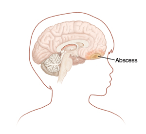 Outline of child's head turned to side showing head and brain. Abscess is in front part of brain.
