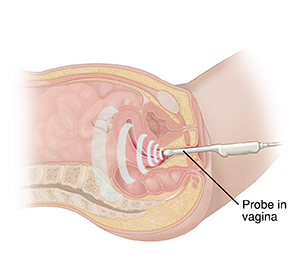 Side cross section of female pelvic area showing ultrasound transducer probe in vagina.