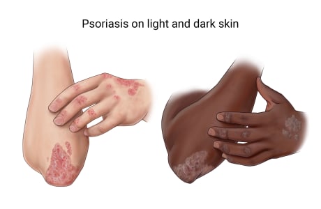 Psoriasis on hand and elbow of light skin and dark skin.