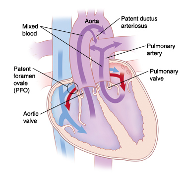 Inside view of heart with TGA, shows patent foramen ovale, patent ductus arteriosus, and blood flow.