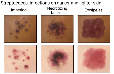 Streptococcal infections on darker and lighter skin, showing impetigo, necrotizing fasciitis, and erysipelas.