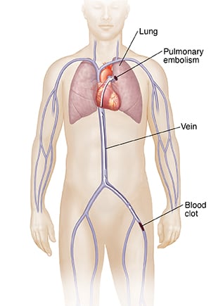 Front view of figure with arrow showing path of blood clot from leg vein to lung, causing pulmonary embolism.